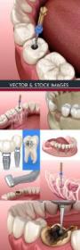 DesignOptimal - Treatment of tooth and removal nerve 3d illustration