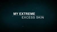 My Extreme Excess Skin S02E04 720p WEB H264-GIMINI[eztv]